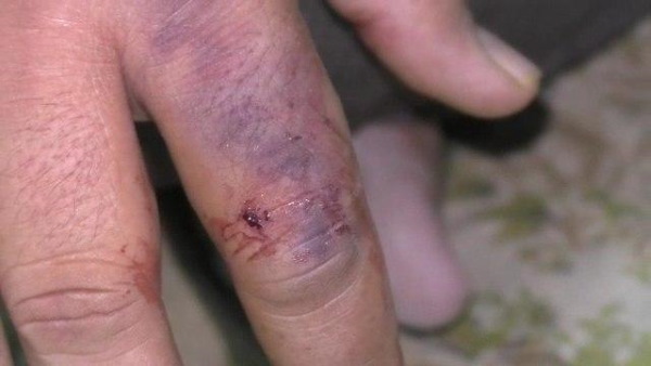  हाथ की अंगुलियों पर सर्पदंश के निशान