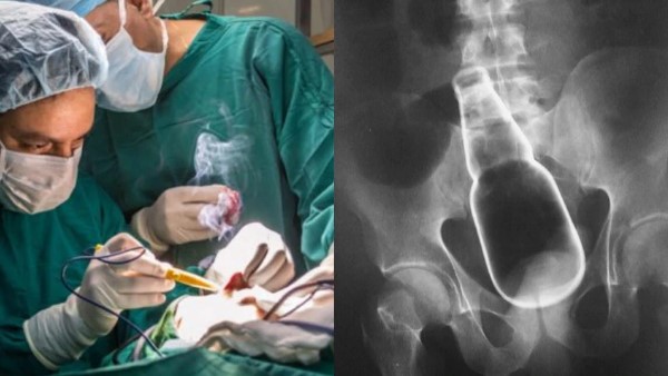 2 घंटे की सर्जरी के बाद निकली गई बोतल