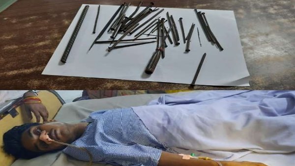 एक्स-रे से पेट के अंदर लोहे की सामग्री की मिली जानकारी