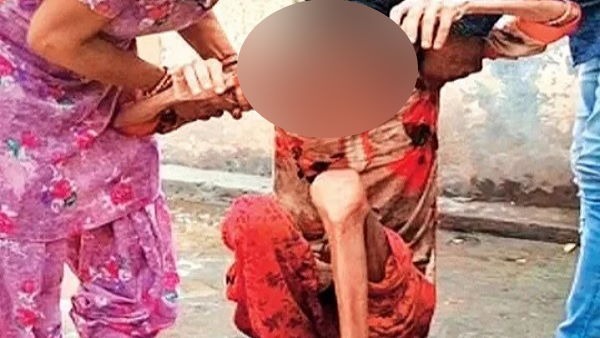 शरीर में सिर्फ हड्डियों का ढांचा बचा शरीर में सिर्फ हड्डियों का ढांचा बचा