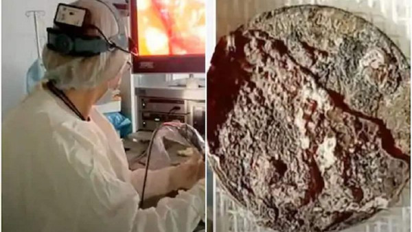  50 साल से नाक में फंसा रहा सिक्का 