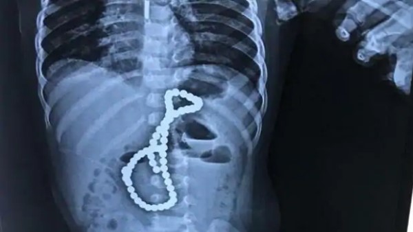 आंतों में आपस में चिपक गए थे चुंबक के मोती