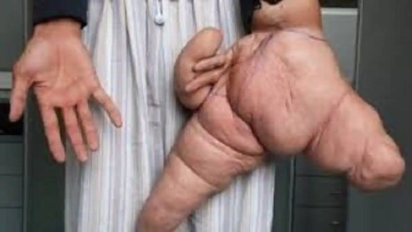 प्रोटियास सिंड्रोम नामक दुर्लभी रोग से हड्डियां का विकास रुक जाता है प्रोटियास सिंड्रोम नामक दुर्लभी रोग से हड्डियां का विकास रुक जाता है