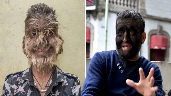 वेयरवोल्ड सिंड्रोम भी ऐसी ही एक दुर्लभ बीमारी है, त्वचा अकड़ जाती है वेयरवोल्ड सिंड्रोम भी ऐसी ही एक दुर्लभ बीमारी है, त्वचा अकड़ जाती है