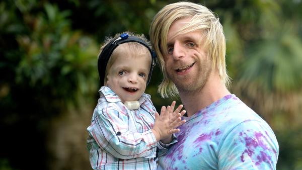 जोनो के गालों में नहीं है हड्डियां