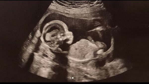 पहली प्रेगनेंसी के बाद दूसरी प्रेगनेंसी