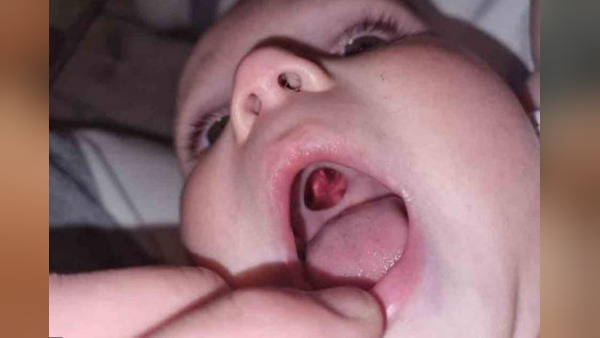 मुंह में सुराख देखकर मां के छूटे पसीने मुंह में सुराख देखकर मां के छूटे पसीने