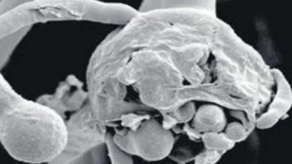 क्यों होगा है फंगल इंफेक्शन