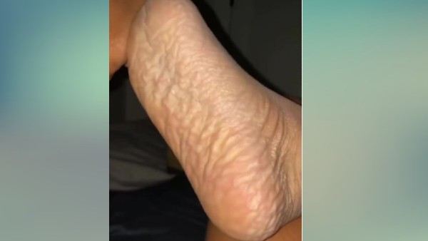 महिला को हुई ट्रेंच फुट की समस्या