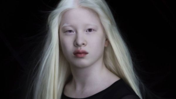 क्या होता है एल्बिनिज्म ? क्या होता है एल्बिनिज्म ?