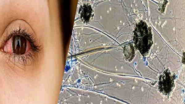 five people died due to black fungus in igims hospital five people died due to black fungus in igims hospital