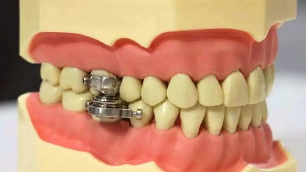  दांतों पर लगेगा ताला