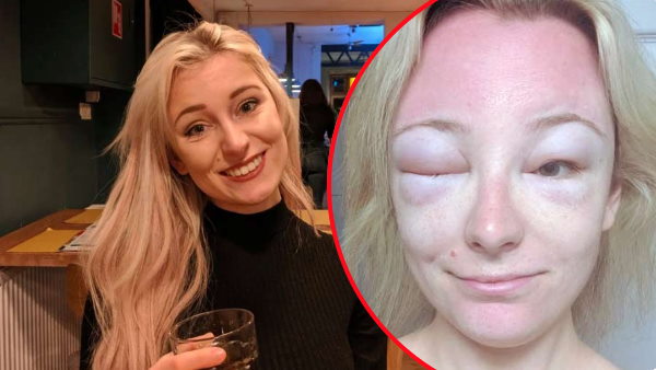 चेहरे पर सनक्रीम लगाना भूली