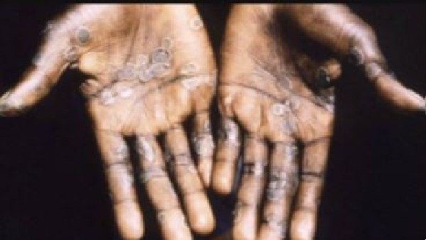 इस वायरस से हो सकती है मौत