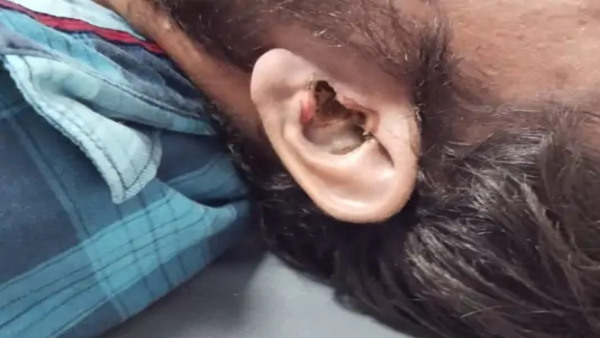 कान से बहने लगा था खून 