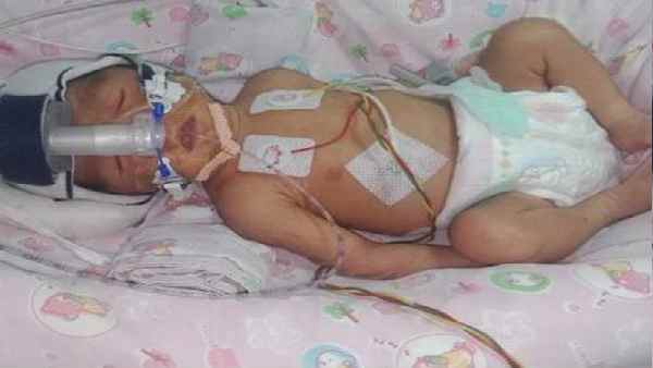 डॉक्टरों की सोच से भी कम वजन था डॉक्टरों की सोच से भी कम वजन था
