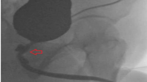 गड़बड़ी की वजह से शख्स की बॉडी में इन्फेक्शन हो गया गड़बड़ी की वजह से शख्स की बॉडी में इन्फेक्शन हो गया