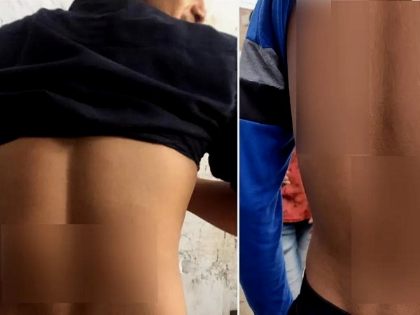 Fatehabad: 40 students beaten with sticks in school, 10 hospitalized, complaint filed Fatehabad: 40 students beaten with sticks in school, 10 hospitalized, complaint filed