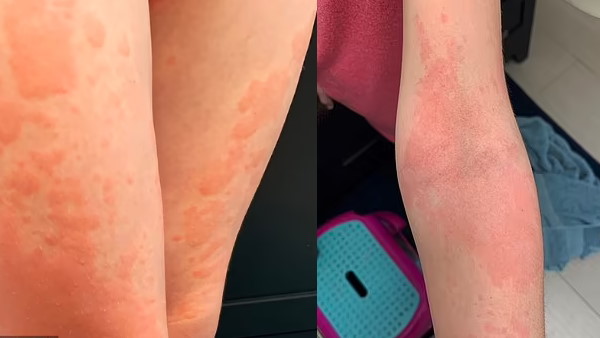 इस वजब से बीमारी को कहा जाता है 'वैम्पायर डिजीज' इस वजब से बीमारी को कहा जाता है 'वैम्पायर डिजीज'