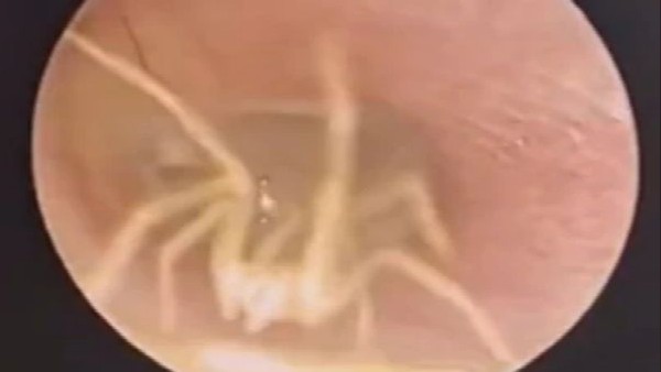 महिला के कान के अंदर जिंदा मकड़ी महिला के कान के अंदर जिंदा मकड़ी