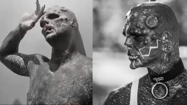 शरीर की स्किन हटवाना चाहते हैं एंथनी