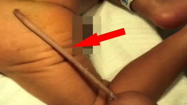 12 सेमी लंबी पूंछ के साथ बच्चे का हुआ जन्म