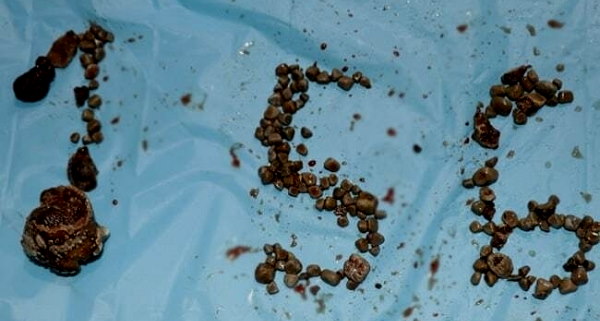 156 kidney stones from a 50-year-old patient 156 kidney stones from a 50-year-old patient