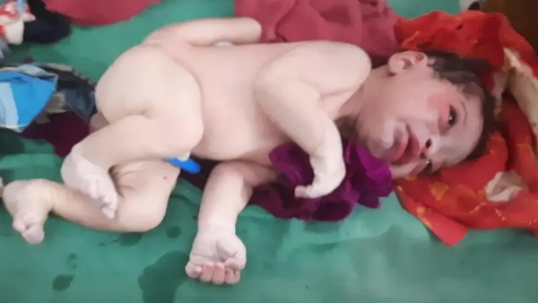 तीन हाथ और तीन पैरों वाला बच्चा का जन्मा