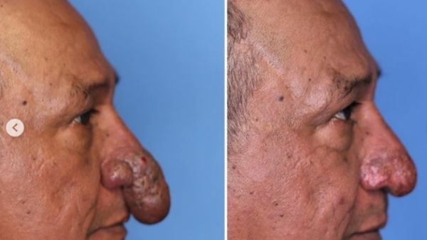 पेनिस जैसा हो गया नाक पेनिस जैसा हो गया नाक