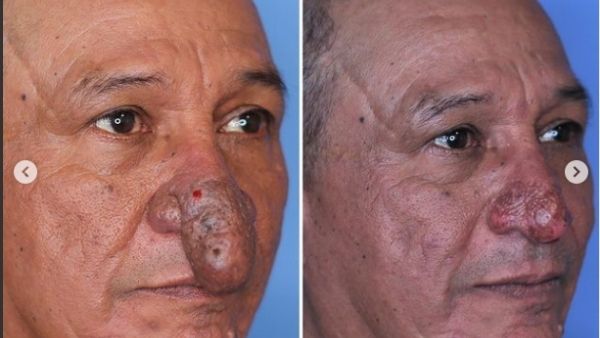 नाक की वजह से काफी दर्द नाक की वजह से काफी दर्द