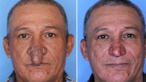 नाक हटाना ही आखिरी विकल्प नाक हटाना ही आखिरी विकल्प