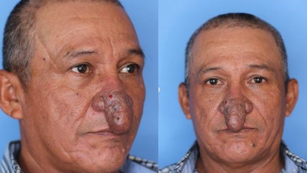 कोनार्डो को था Rhinophyma डिस्ऑर्डर कोनार्डो को था Rhinophyma डिस्ऑर्डर