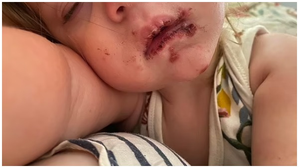 'घंटेभर बाद ही मेरी बेटी को छाले और धब्बे हो गए...' 'घंटेभर बाद ही मेरी बेटी को छाले और धब्बे हो गए...'