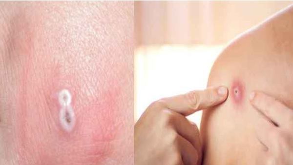 कैसे फैलता है मंकीपॉक्स