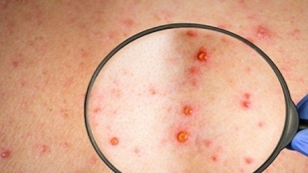 लगातार बढ़ रहे मंकी पॉक्स के मामले लगातार बढ़ रहे मंकी पॉक्स के मामले