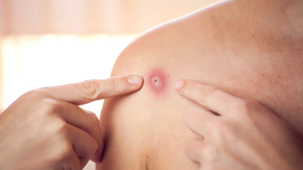 3. सबसे पहले 1970 में मिला था मंकीपॉक्स का केस