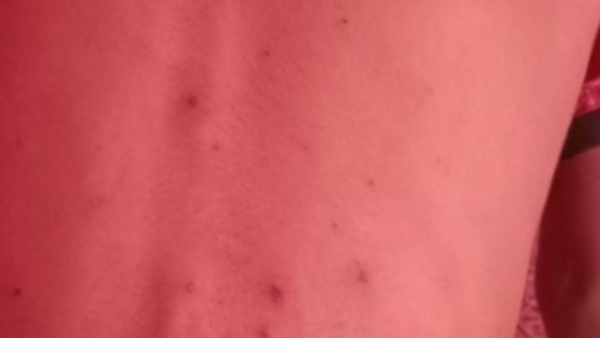 चिकन पॉक्स का इलाज