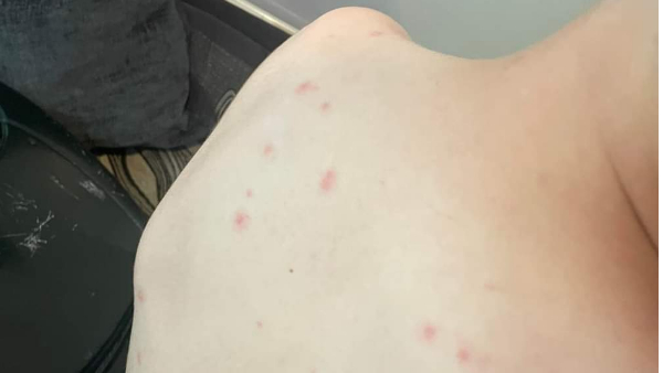 चिकन पॉक्स कौन सी बीमारी और कब होती है ?