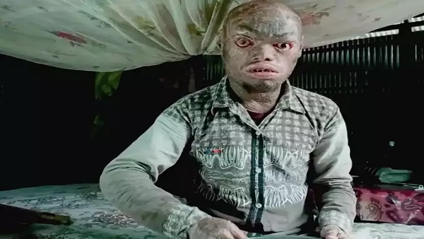  हर हफ्ते निकल जाती है त्वचा