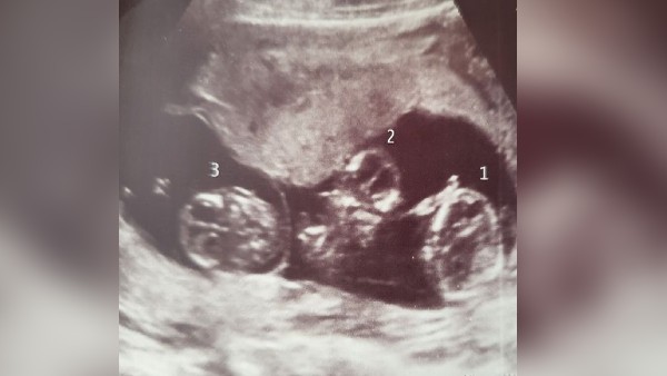 दो बच्चियों की एक नाल, तीसरी की अलग नाल थी