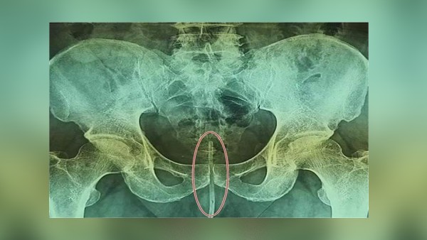 हेल्थ जर्नल यूरोलॉजी केस में पब्लिश रिपोर्ट 