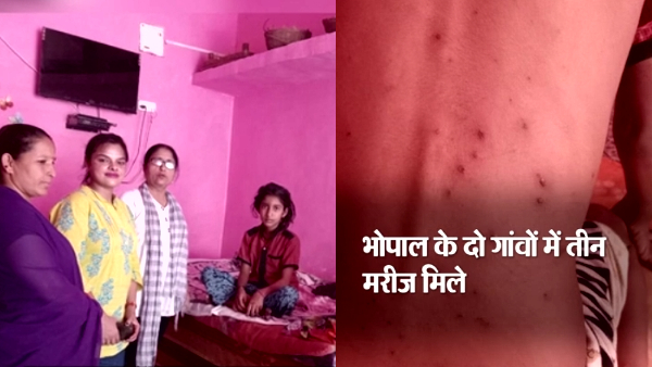 चिकनपॉक्स बीमारी के प्रसार के संबंध में जानकारी चिकनपॉक्स बीमारी के प्रसार के संबंध में जानकारी