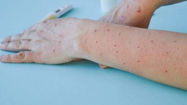 चिकनपॉक्स के प्रमुख लक्षण चिकनपॉक्स के प्रमुख लक्षण