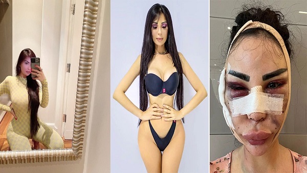 17 साल की उम्र में कराई पहली सर्जरी 