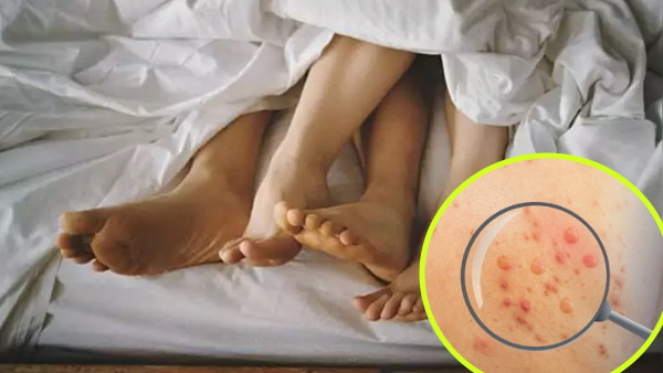 इन वजहों से भी फैल सकता है मंकीपॉक्स