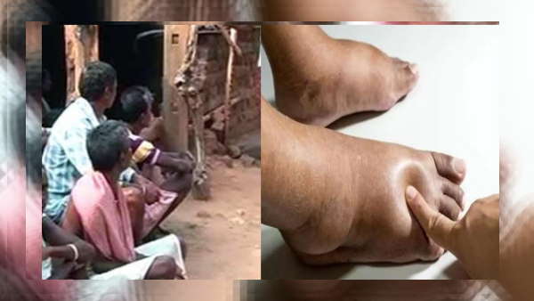 हाथ पैर में आती है सूजन,फिर चली जाती है जान 