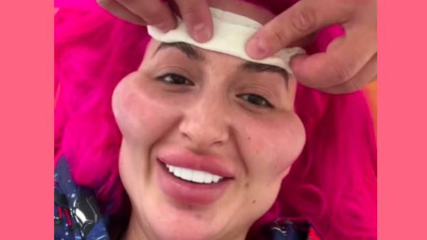 सबसे बड़े गाल के बाद अब चेहरे पर सींग