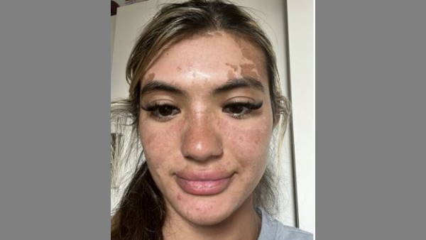 अगले दिन तो और भी हुआ बुरा हाल