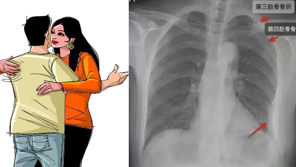 एक्स-रे में निकली तीन टूटी हड्डियां