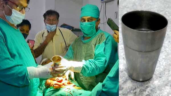 बड़ी आंत काटकर निकाली गई गिलास 